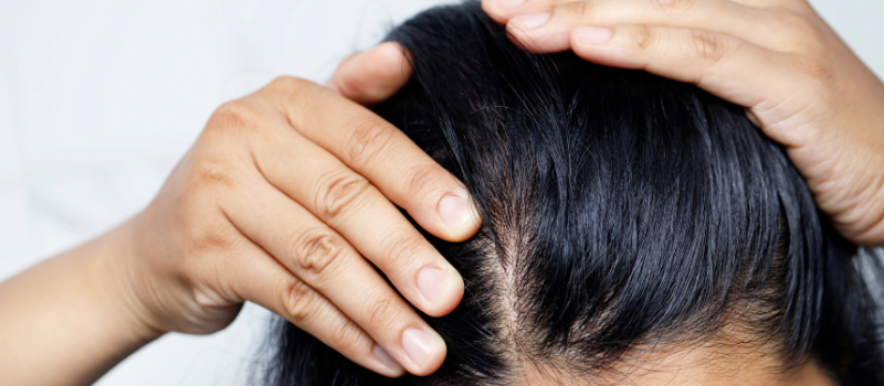 Women experiencing hormonal hair loss